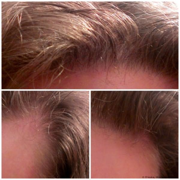 Средство от выпадения волос Атлас-1 «Эсвицин» фото