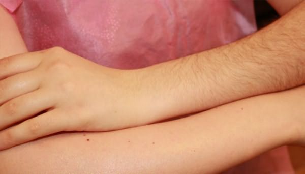 Руки девушки до и после эпиляции воском