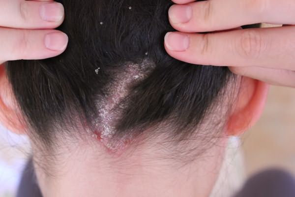 Масштабное поражение дерматитом заканчивается потерей волос