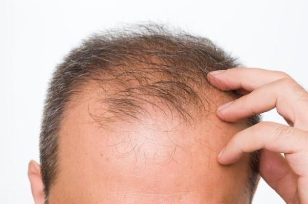 средства предотвращающие выпадение волос