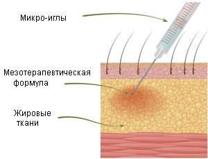 На рисунке показан процесс введения при помощи микроиглы лекарственного вещества в серединный слой кожи.