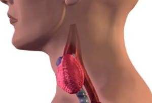 При проблемах со щитовидной железой иногда возникает похожая клиническая картина