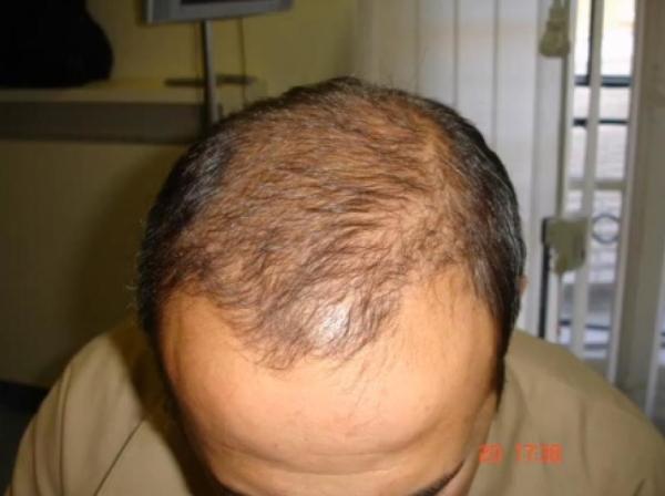 Настойка перца от выпадения волос прекрасно подойдет и мужчинам для борьбы с облысением.